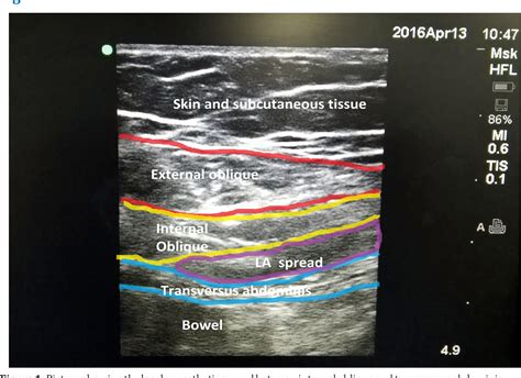 PDF Ultrasound Guided Bilateral Ilioinguinal And Iliohypogastric