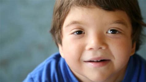 Discover Noonan Syndrome Causes Symptoms Treatment