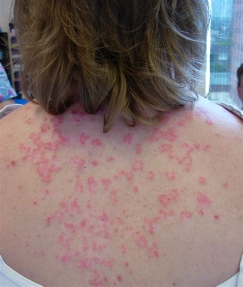 Lupus Skin Rashes