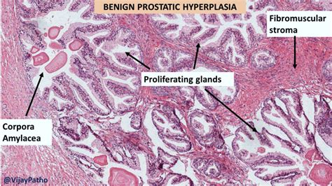 Benign Prostatic Hyperplasia BPH Pathology Made Simple