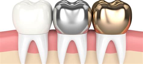 Dental Crowns Types Cost Procedures Advantages Thornhill Dental