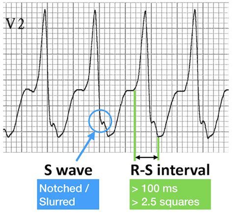 Vt Versus Svt • Litfl Medical Blog • Ecg Library Basics