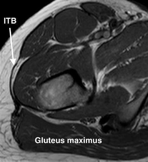 Gluteus Medius Tendinopathy Mri