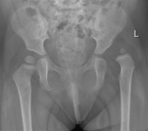 Developmental Dysplasia Of The Hip Doctor Pmm