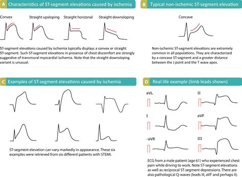 Stemi St Elevation Myocardial Infarction Diagnosis Criteria Ecg