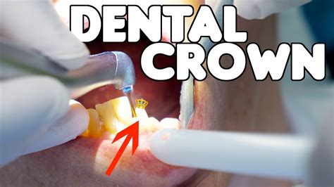 Dental Crown Procedure Explained Youtube