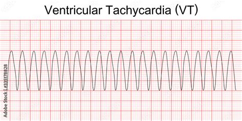 Electrocardiogram Show Monomorphic Ventricular Tachycardia Vt