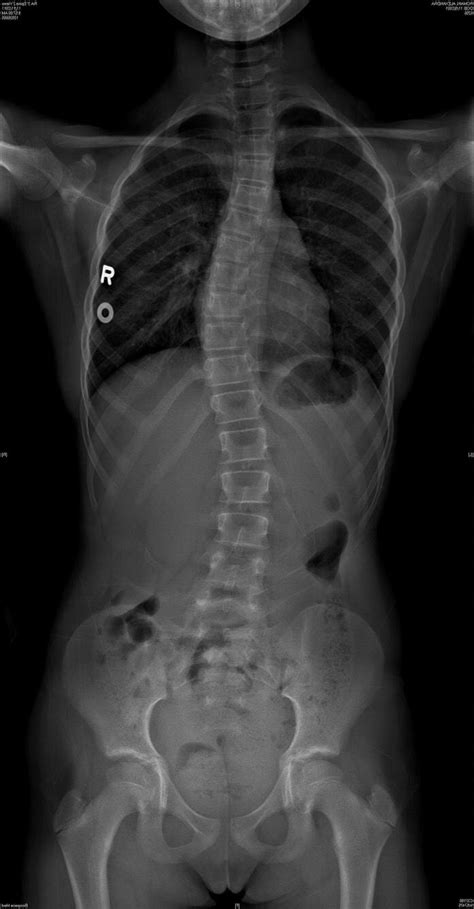 Read And Interpret X Ray And Radiologists Report For Scoliosis — Lyons