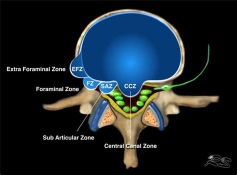 Types Of Disc Herniation