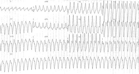 Ventricular Tachycardia Ecg