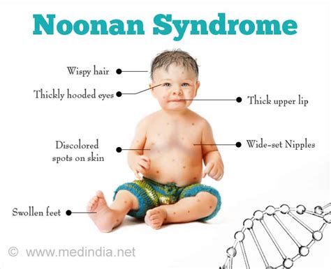 Goldenhar Syndrome Pictures Symptoms Causes Prognosis