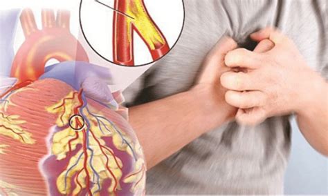 What Is Acute Coronary Syndrome Corrielus Cardiology Cardiologists