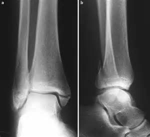 • following ankle supination with external rotation. Medial Malleolus Avulsion Fracture