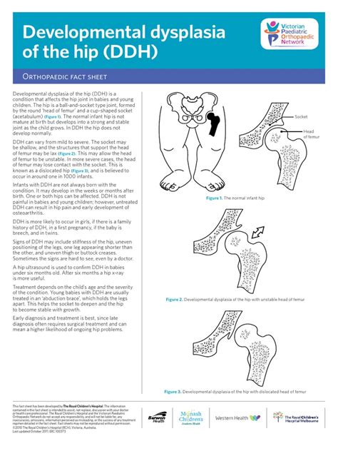 Dysplasia Hip Facts Medical Specialties Clinical Medicine