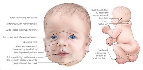 Noonan Syndrome AAFP