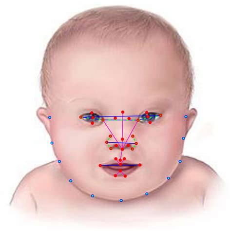 Noonan Syndrome