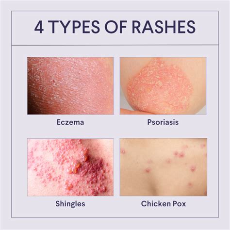 Common Causes Of Rashes A Rash Mi Uk