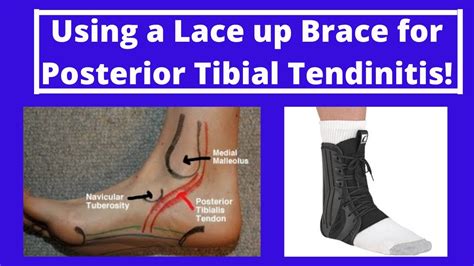 Using A Lace Up Brace For Posterior Tibial Tendinitis Youtube