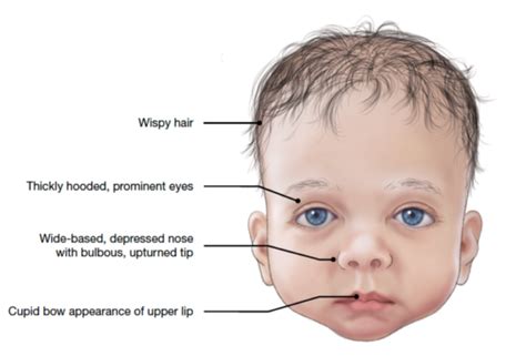 FAQs Facial Features Noonan Syndrome Association