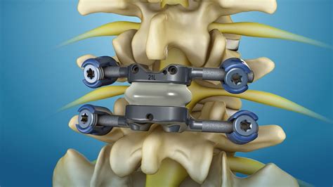 Premia Spine Announces Fda Breakthrough Device Designation For Its Tops