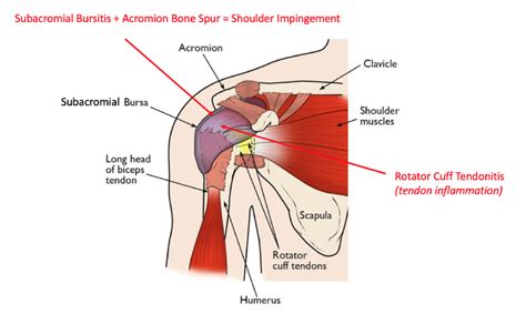 Subacromial Bursitis Shoulder Procedures Sydney Shoulder Unit