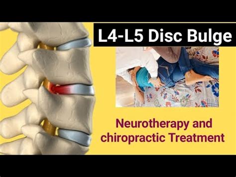 L4 L5 Disc Bulge Annular Tear Treatment Chiropractic Treatment For Back