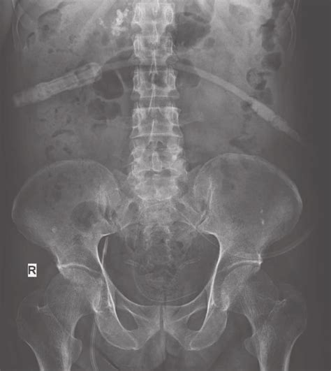 Post Capd Catheter Insertion Abdominal X Ray Confirming The Tip