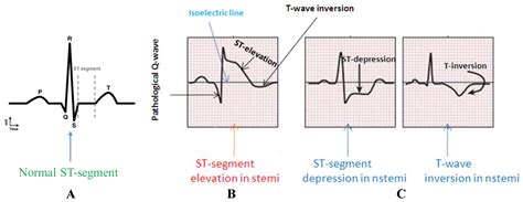 Nstemi Myocardial Infarction Cardiology Geeky Medics