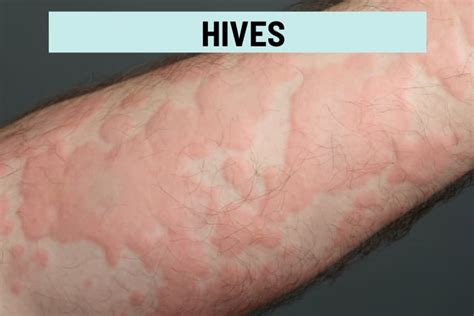 Itchy Bumps On Skin 21 Causes Pictures And Treatment