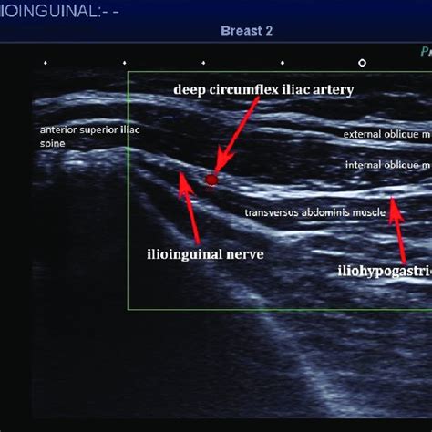 PDF Selective Spinal Nerve Block In Ilioinguinal Iliohypogastric And