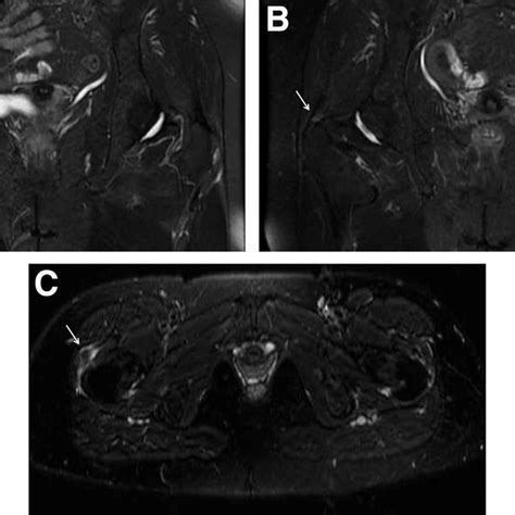 A Isolated Partial Thickness Gluteus Medius Tear T2 Weighted Coronal