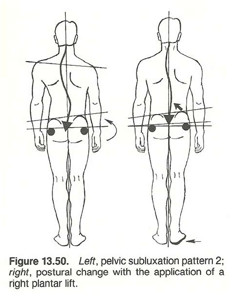 Scoliosis Pelvic Tilt