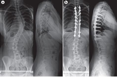 Xray Versus Eos For Scoliosis Schroth Scoliosis