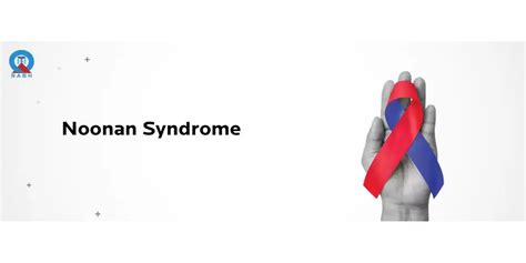 Noonan Syndrome Causes Symptoms And Treatment Options