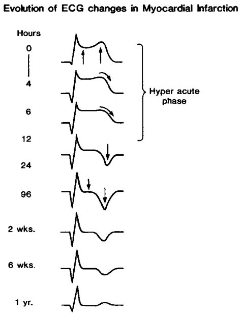 Stemi Ecg Evolution