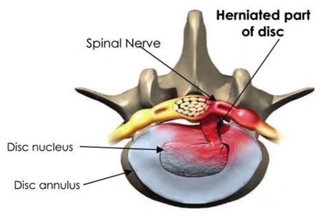 Bulging Disc Lumbar Spine