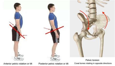 How To Fix Pelvic Torsion Twisted Pelvis With Clinical Somatics