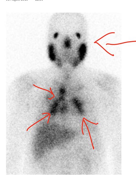 Recent examples on the web in the united states, the lambda variant has been implicated in fewer than 700 cases. Sarcoidosis : Gallium Scan - Sumer's Radiology Blog