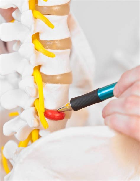 Lumbar Laminectomy Adelaide Adelaide Neurosurgery Centre