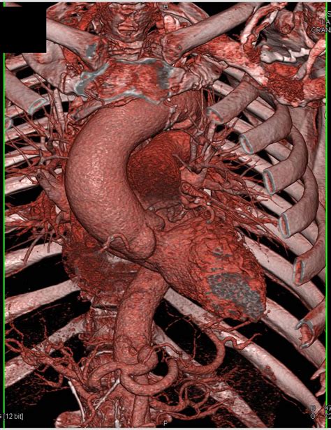 Dilated Aortic Root And Ascending Aorta Chest Case Studies Ctisus