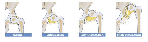 Hip Dysplasia Types Carrying Matters