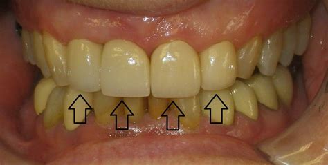 Dental Crowns Before And After Photos Thornhill Dental