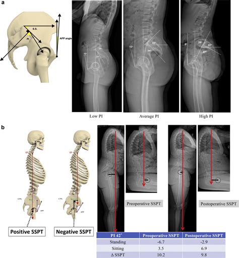 Pelvic Tilt Anatomy Human Anatomy