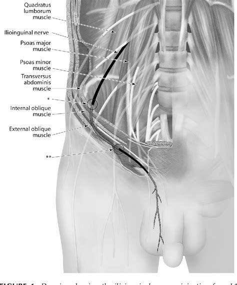 Ilioinguinal Nerve Entrapment