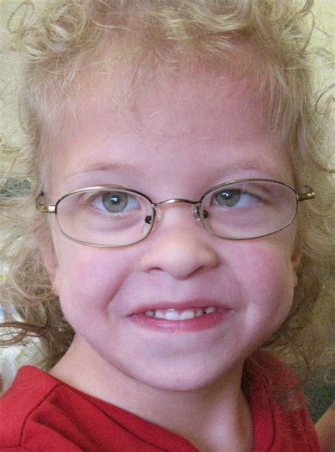 Pictures Of Noonan Syndrome