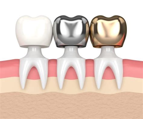 The Different Types Of Dental Crowns Metro Smiles Dental Forest Hills