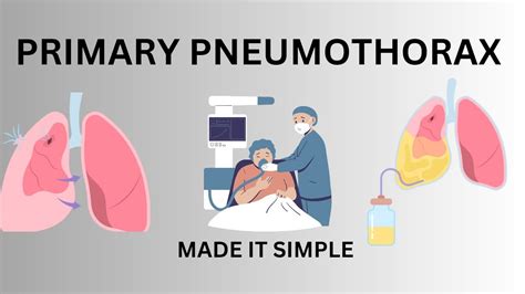 Pneumothorax Causes Symptoms Treatment Pneumothorax