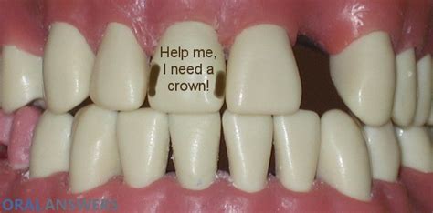 Dental Crown Procedure What Is A Dental Crown Cap Oral Answers