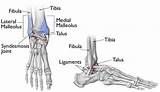 I rolled my right ankle at work in the woods april 20, 2016. Ankle Fractures (Broken Ankle) - OrthoInfo - AAOS