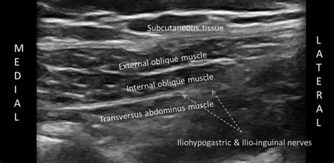 The Ilio Inguinal And Iliohypogastric Nerve Blocks With Local